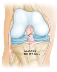 Avoiding ACL Injuries