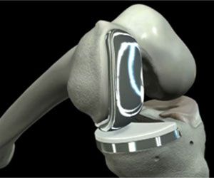 ConforMIS-iUni1