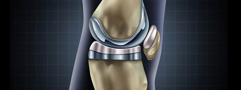 Access Sports Medicine Free Education Series: Partial Knee Replacements with Bruce Gomberg, MD