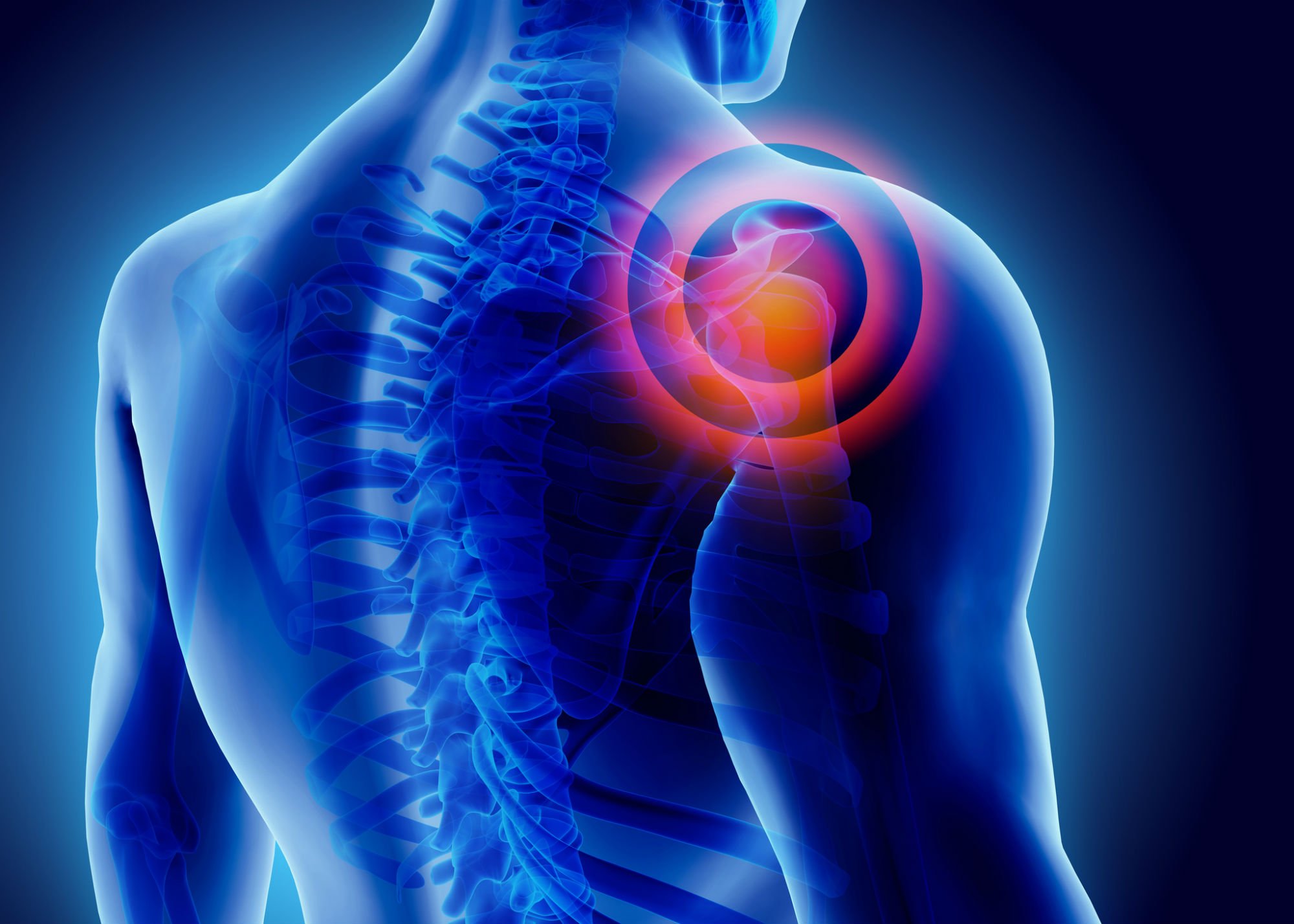 What is Frozen Shoulder (Adhesive Capsulitis)? Symptoms & Causes