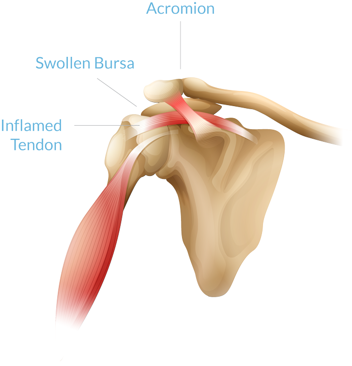 Post Op Shoulder Care - Part 6 Sleeping with a Sling -   Shoulder  surgery recovery, Rotator cuff surgery, Shoulder surgery