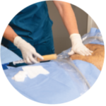 Lipoaspiration