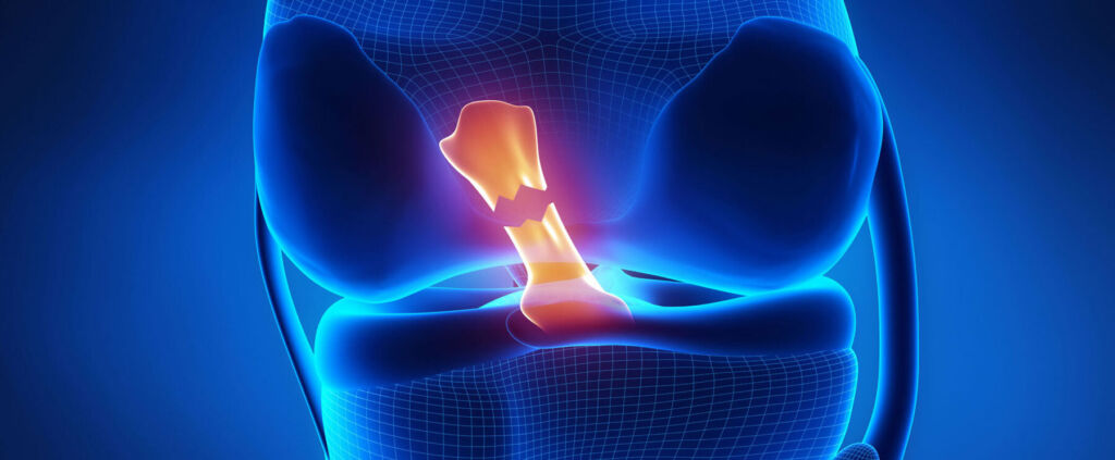 acl tear