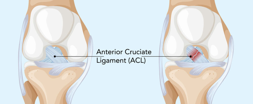 what is the acl